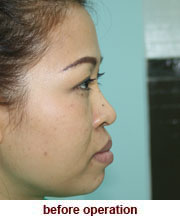 plastic_surgery_augmentation_rhinoplasty